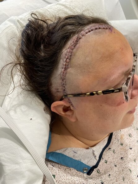 Image of Kristin's scar from the brain surgery.